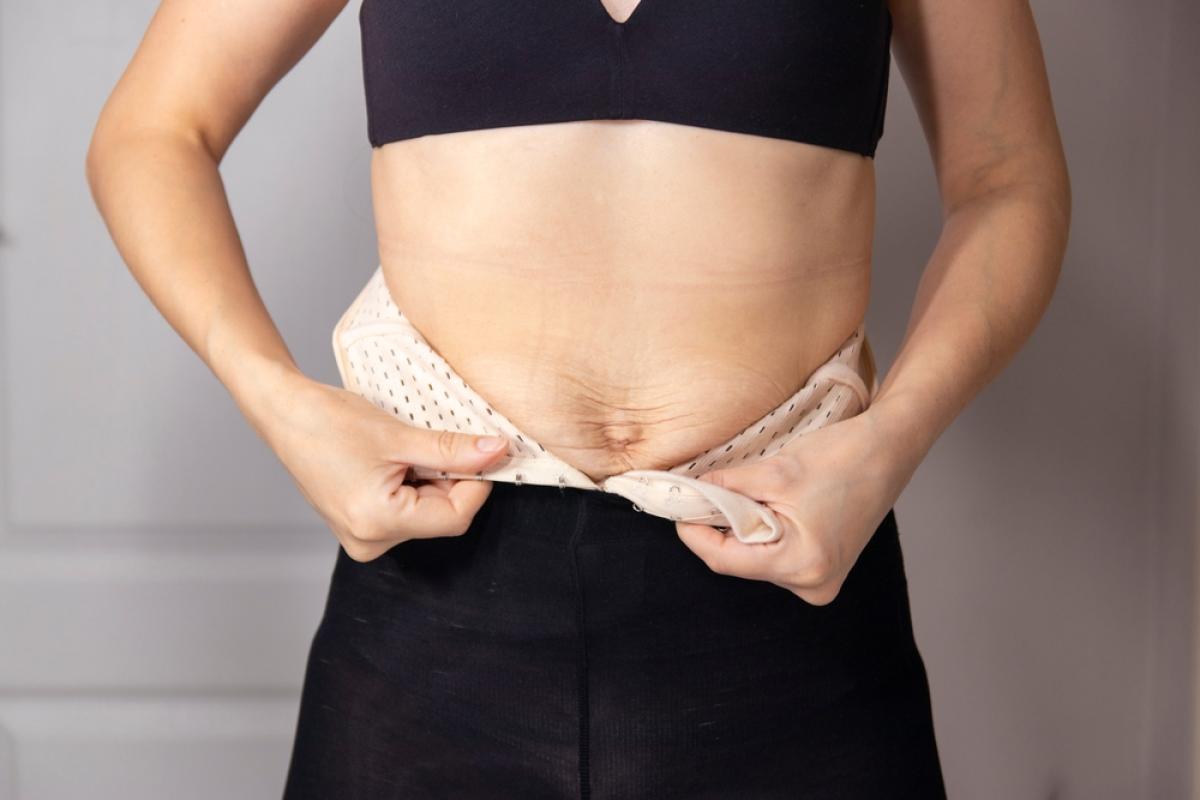 Can A Tummy Tuck Fix Abdominal Muscle Separation? by dynamicaesthetic