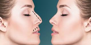Rhinoplasty In Riyadh: Combining Beauty And Function For Best Results by enfieldroyalsaudi050