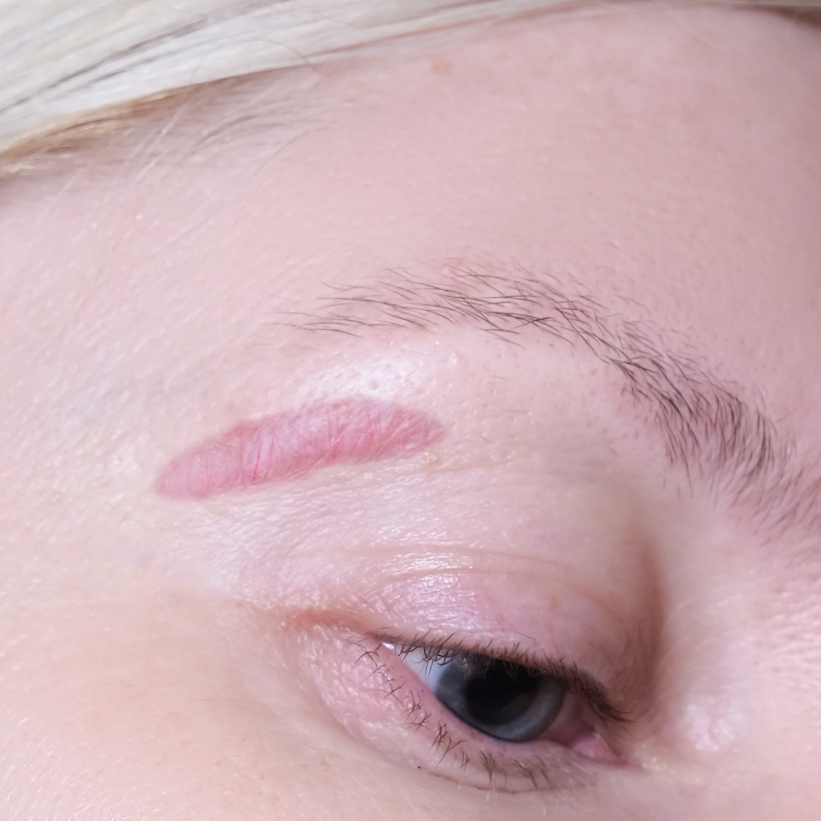 How Effective Is Keloid Treatment In Stopping Regrowth? by Dynamic Life Clinics