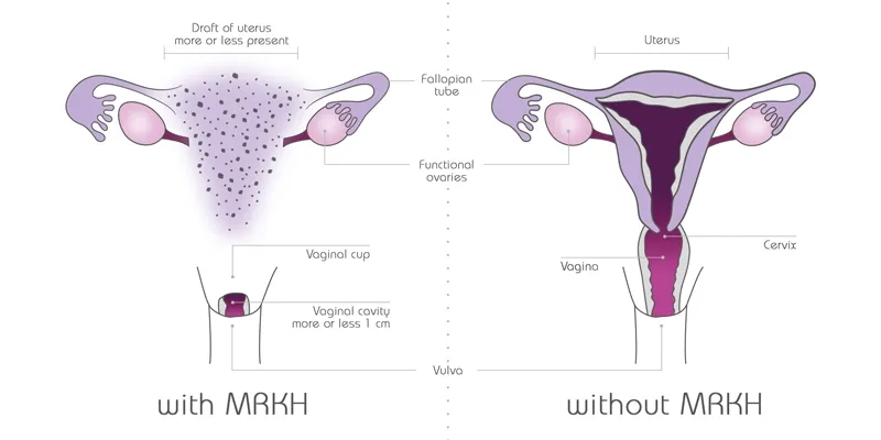 depiction of womb with and without mrkh depiction of womb with and without mrkh