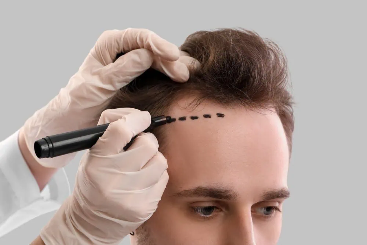 How Is The FUSS Hair Transplant Procedure Performed? by cdynmic