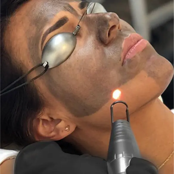 How Does Pico Laser Help With Skin Rejuvenation? by cdynmic