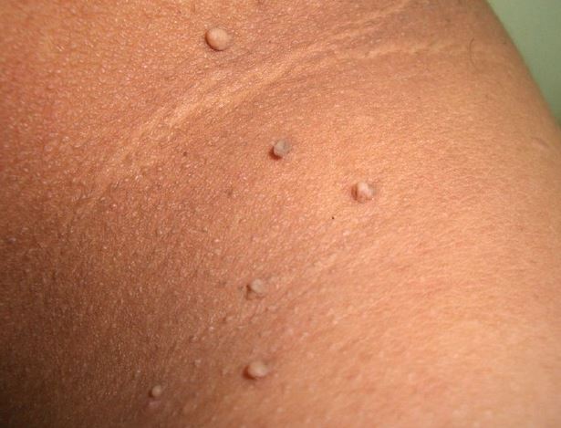 How Does Temperature Affect Instant Skin Tag Removal? by Bisma jamal