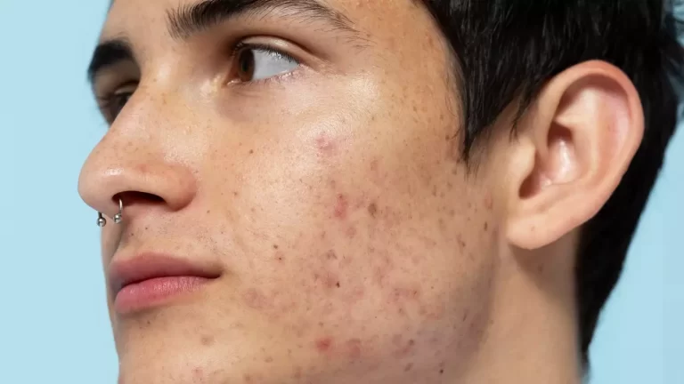 What Type Of Pimple Treatment Works Best For Dry Skin? by dynamicaesthetic