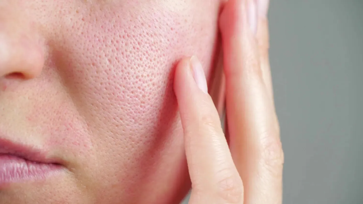 Which Skincare Treatments Help Minimize The Appearance Of Large Pores? by cdynmic