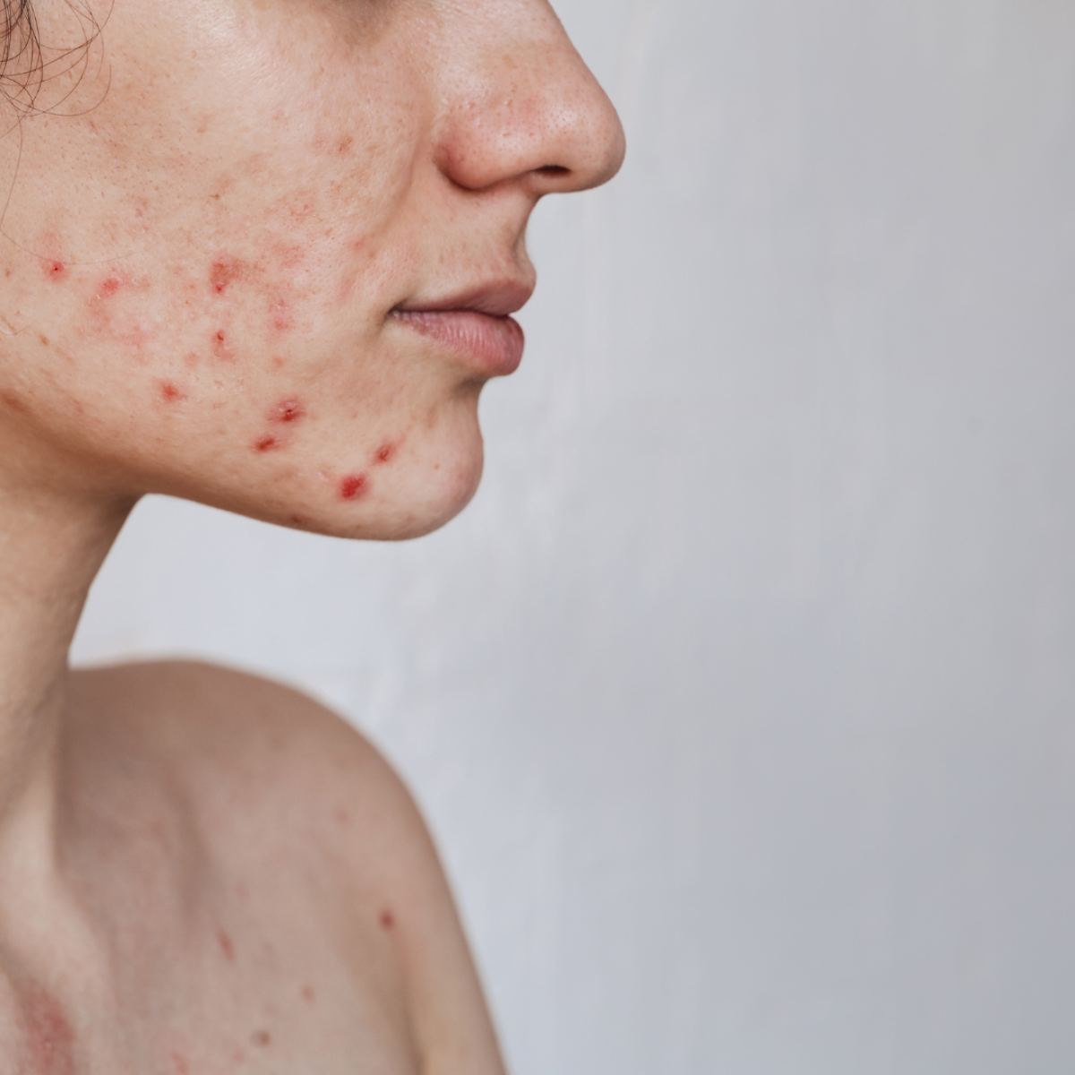 Achieve Radiant Results With Innovative Acne Treatment Dubai by pookie46