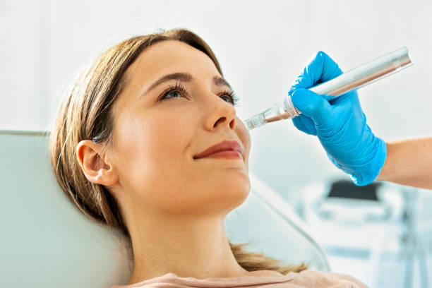 Is Microneedling For Acne Scars Good For Teen Scars? by Enfieldabudhabi