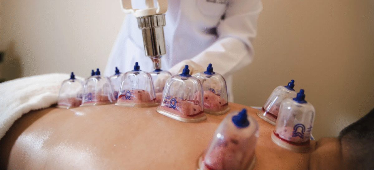 Recharge Your Mind And Body Through Hijama Cupping Therapy by pookie46