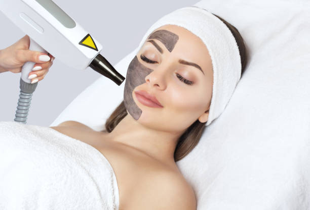 Does Laser Carbon Peel Remove Tan? by Enfieldabudhabi