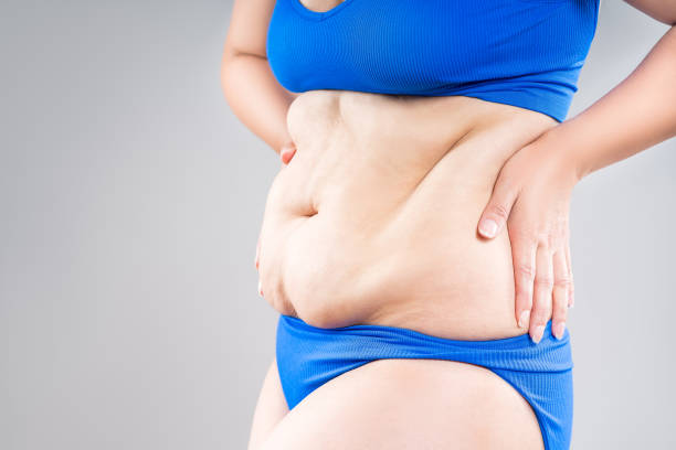 Tummy Tuck Vs. Liposuction: Which One Is Right For You? by mominenfield