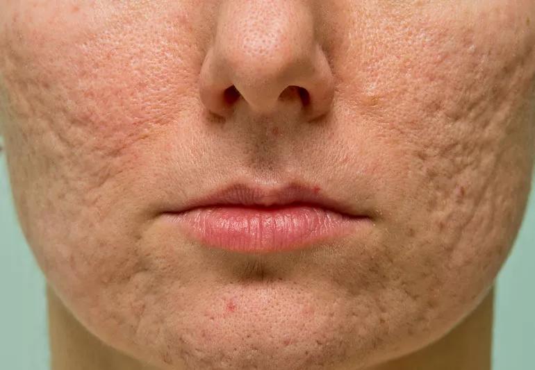 Is Professional Acne Scar Treatment Worth The Investment? Is Professional Acne Scar Treatment Worth The Investment? by MuhammadAhmad