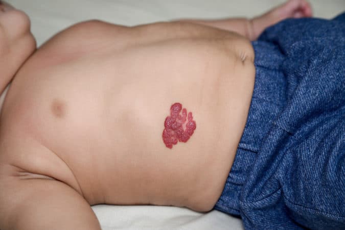 What Is The Most Effective Method For Birthmark Removal? by dynamicaesthetic