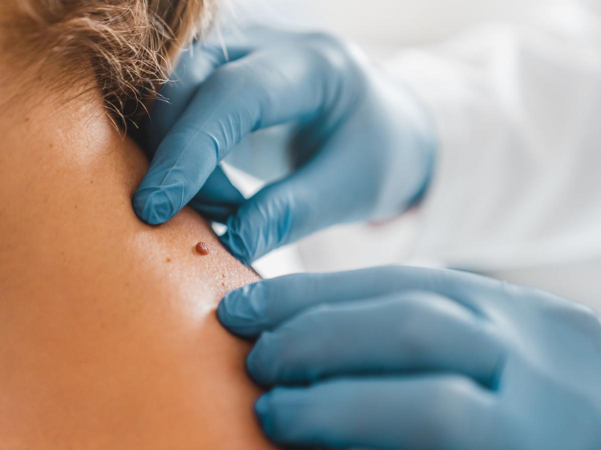 How Is Skin Tag Removal Usually Performed? by dynamicaesthetic