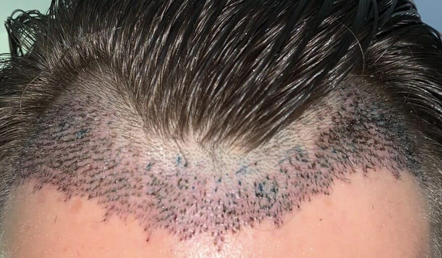 How Does A Hair Transplant Differ For Women? by Ahmad Hassan