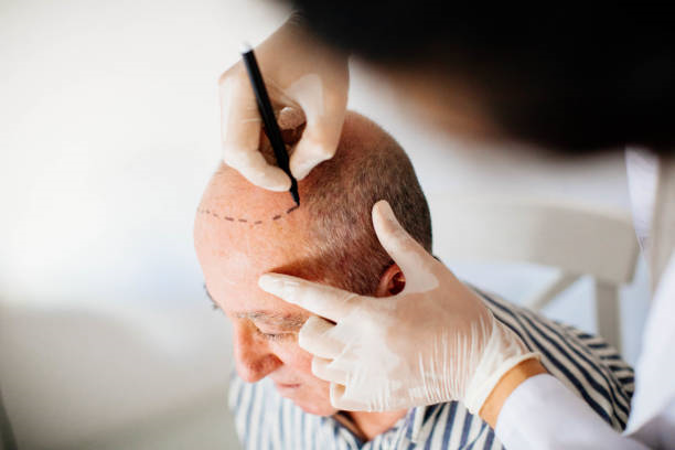 Why Hair Transplant In Riyadh Is An Effective Solution For Baldness by enfieldroyalsaudi050
