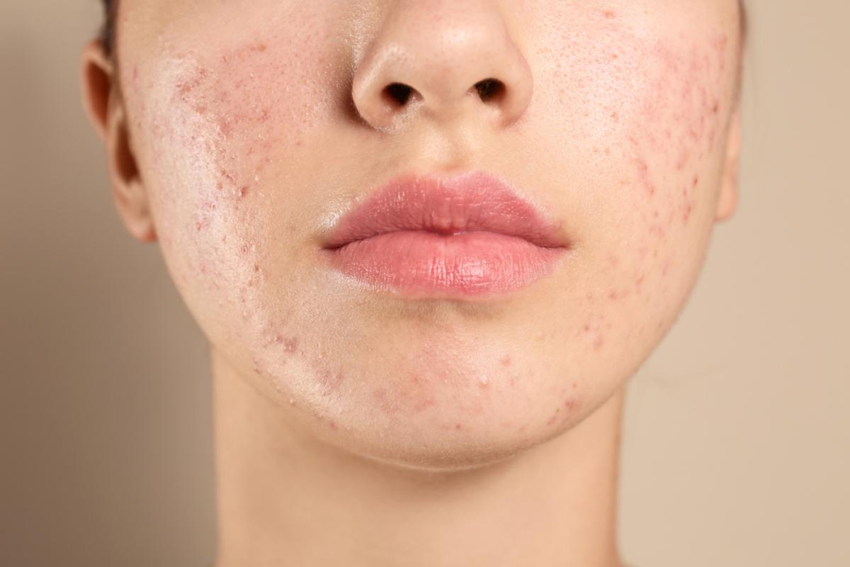 What’s The Difference In Acne Treatment For Teens? What’s The Difference In Acne Treatment For Teens? by eirhakhan