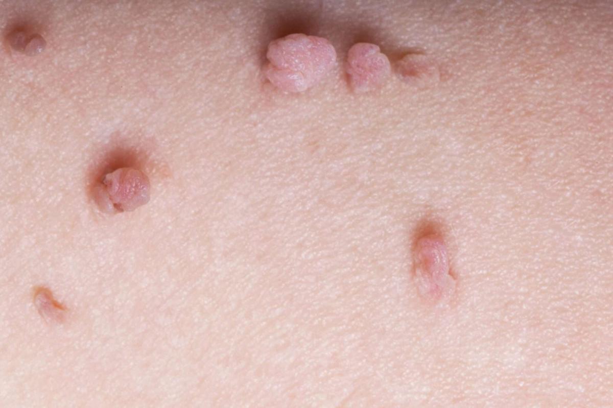 Does Skin Tag Removal Require Stitches? Does Skin Tag Removal Require Stitches? by MuhammadAhmad