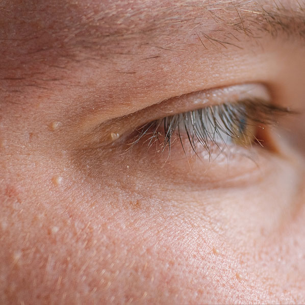 What Are Milia And How To Treat Them? by fatimadynamic