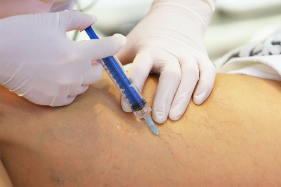 How Does Sclerotherapy Address Vascular Concerns? by Ahmad Hassan