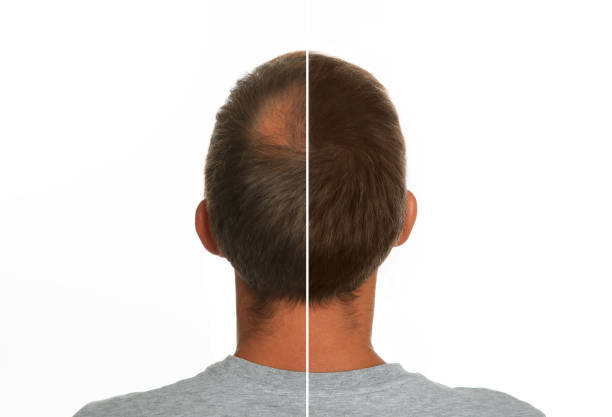 Permanent Solutions: Hair Transplant Riyadh by mominenfield