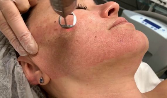 How Can Fotona 4D Facelift Boost Collagen Production? by Dynamicclinic12