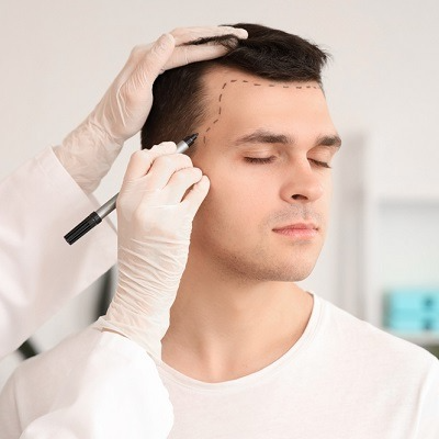 How Effective Is A Hair Transplant For Receding Hairlines? How Effective Is A Hair Transplant For Receding Hairlines? by MuhammadAhmad