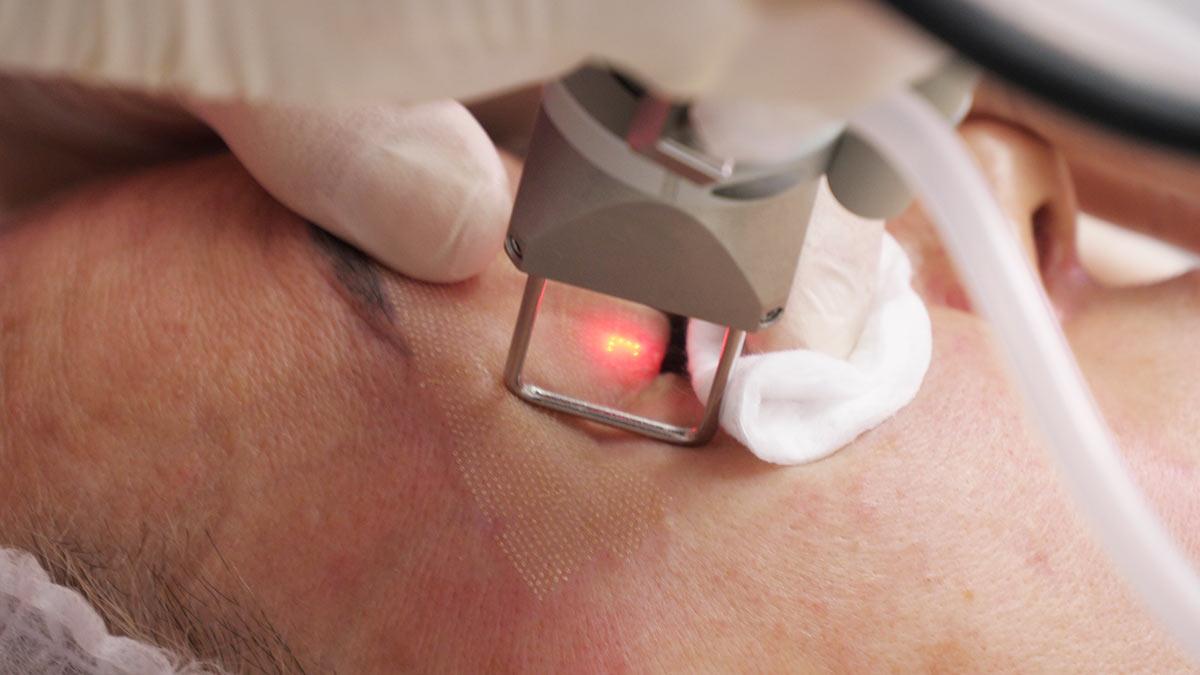 Want Baby-soft Skin With An Erbium Peel? by Dynamicclinic12