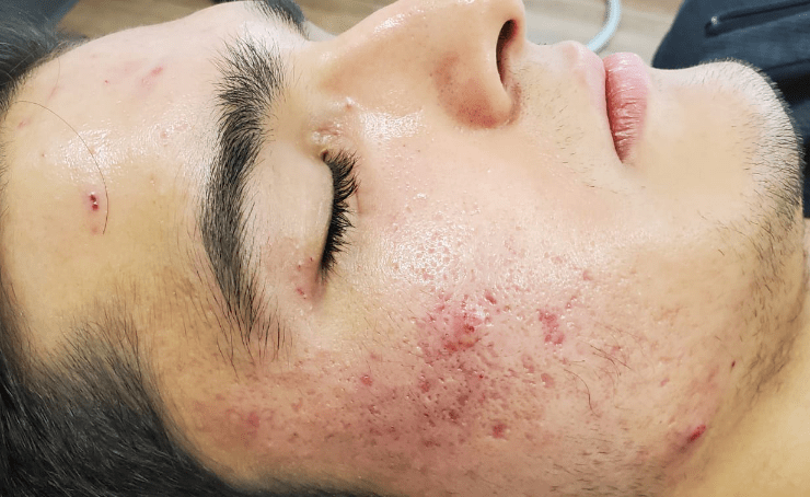 What Pimple Treatment Works Best For Men’s Skin? by dynamicaesthetic