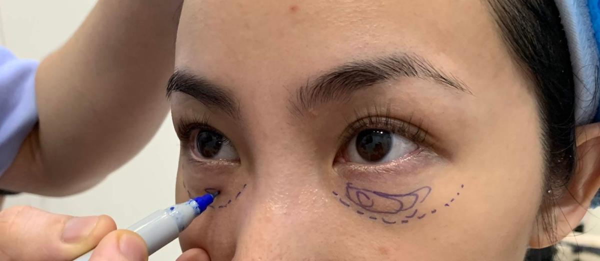 Is Eyelid Surgery Right For You? by Dynamicclinic12