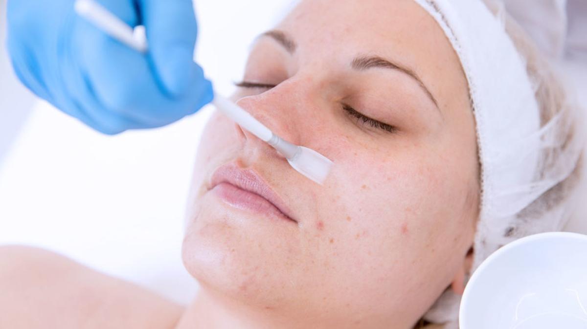 Can Chemical Peels Help In Managing Active Acne? by dynamicaesthetic