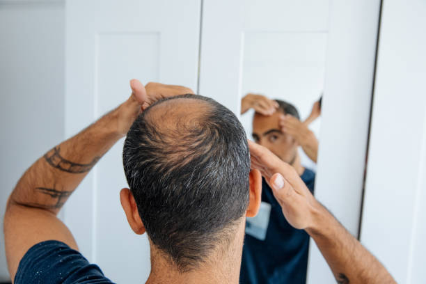 Does Hair Loss Treatment Help With Severe Hair Fall? by Enfieldabudhabi