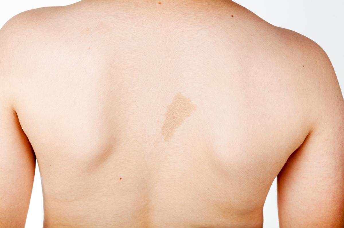 What Is The Science Behind Birthmark Removal? What Is The Science Behind Birthmark Removal? by eirhakhan
