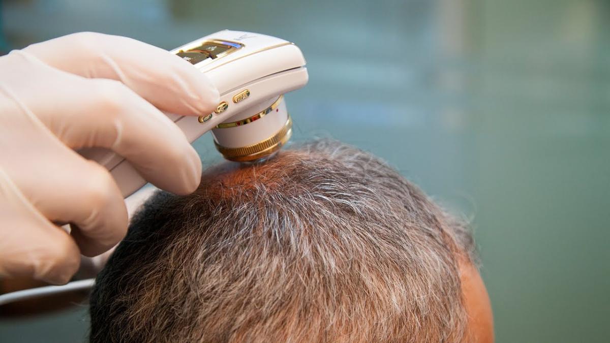 Can A Trichologist Prevent Future Hair Loss? by Enfieldabudhabi