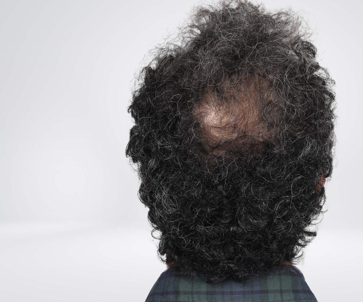 Can Crown Hair Transplant Work On Curly Hair Types? by fatimadynamic