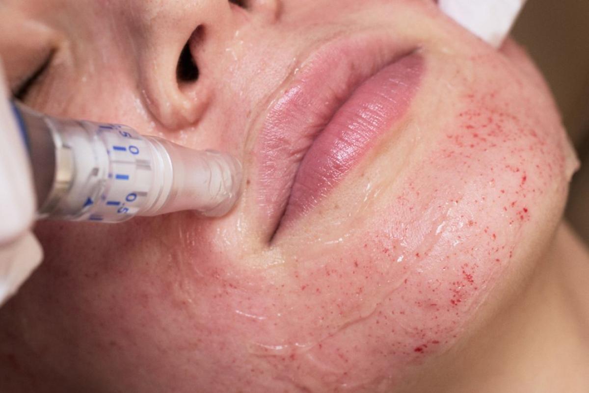 The 2025 Skin Reset That Actually Fixes Acne Scars, Pores & Glow by Sadia Rehmat