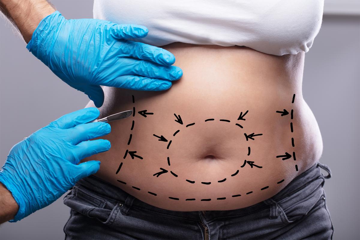 Mini Abdominoplasty For Quick Lower Tummy Tightening? by Dynamicclinic12