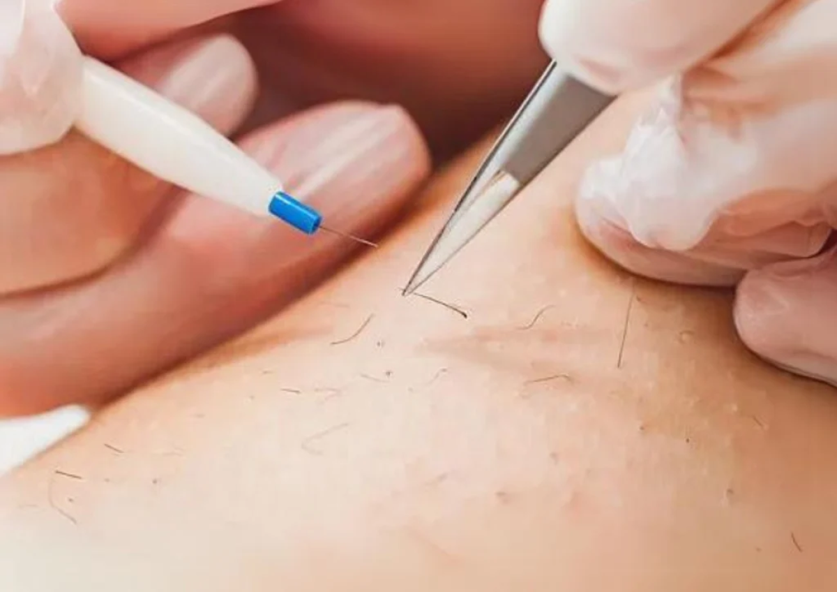 What Makes Electrolysis Hair Removal Unique? What Makes Electrolysis Hair Removal Unique? by eirhakhan