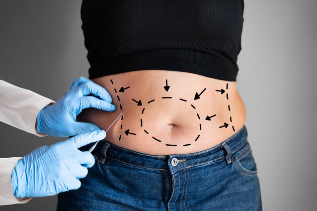 Is Liposuction Faster Than Dieting For Fat Reduction? by glamorous