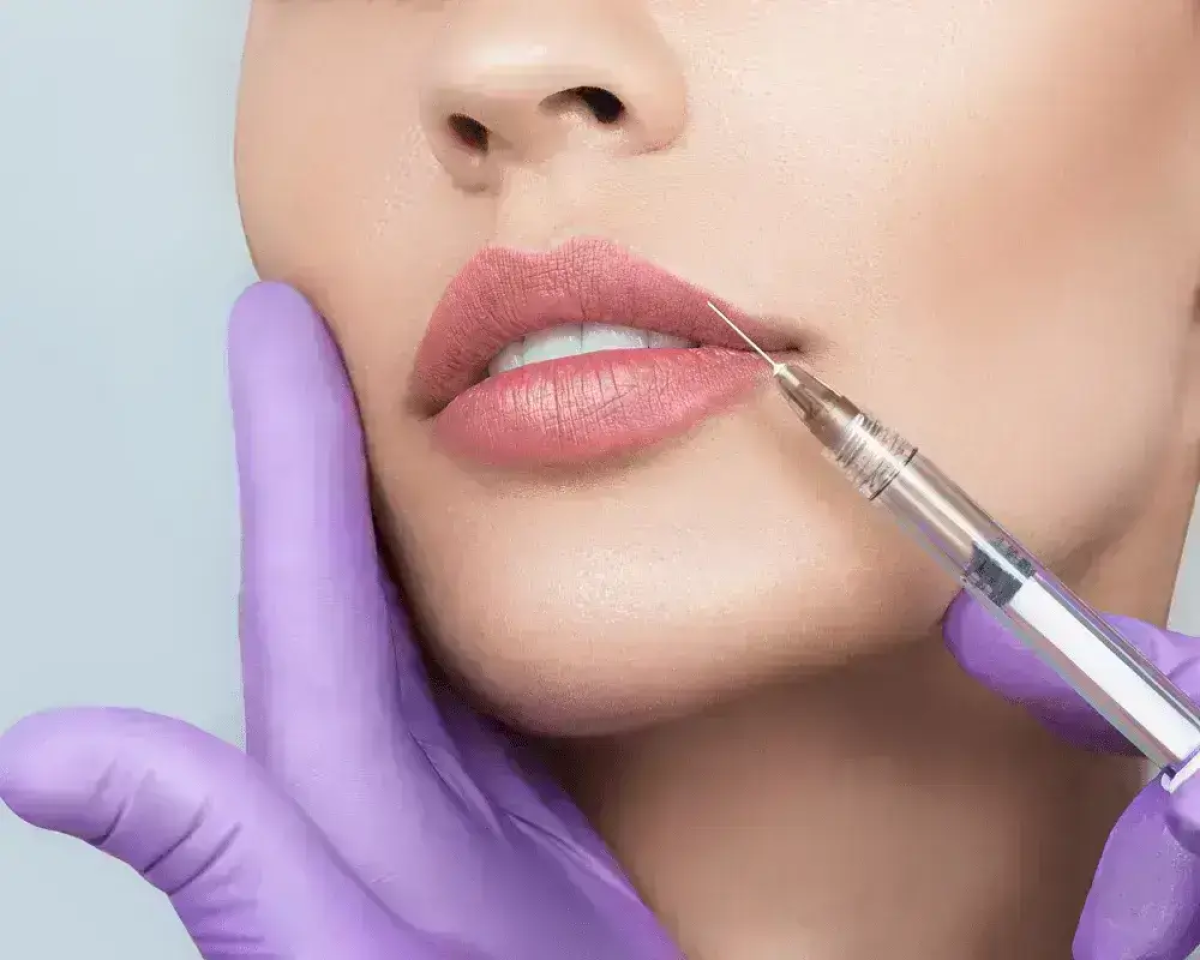How Exactly Do Lip Fillers Work? by dynamicaesthetic