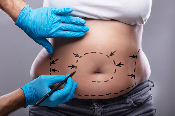 How Safe Is Tummy Tuck As A Body Contouring Treatment? by Enfieldabudhabi