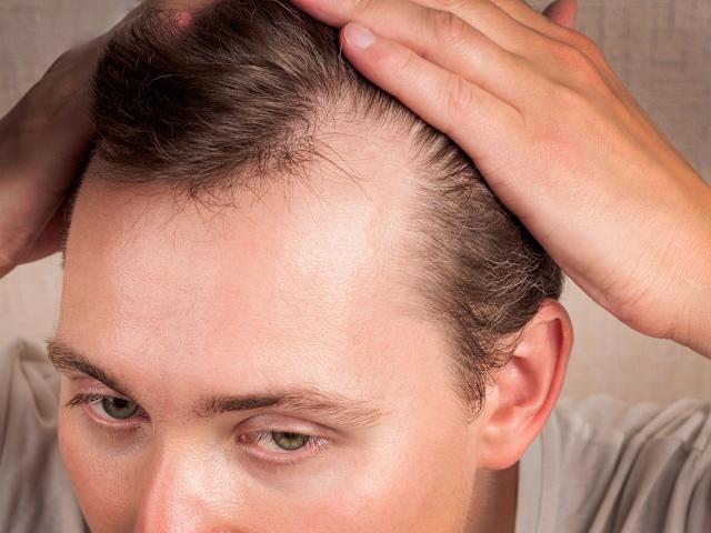 How Does A Hair Transplant Affect Overall Scalp Health? by Dynamic Life Clinics