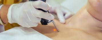 Renew Your Glow Seamlessly With Scar Removal Dubai Solutions by pookie46