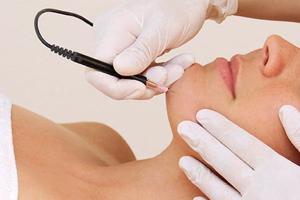 Is Electrolysis Safe For All Skin Types? Is Electrolysis Safe For All Skin Types? by sohail ahmed