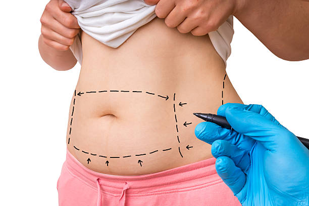 When Is The Best Age To Get A Tummy Tuck ? by Enfieldabudhabi