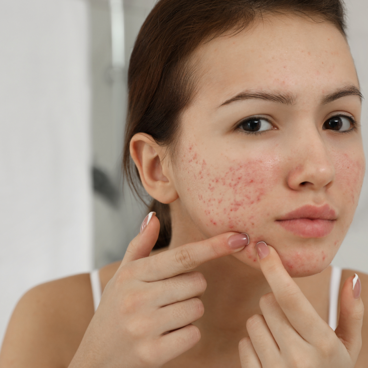 Are Skincare Treatments Effective For Oily And Acne-Prone Skin? by fatimadynamic