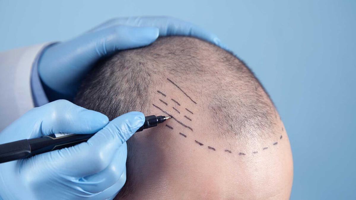 What Is A Crown Hair Transplant? by Dynamicclinic12
