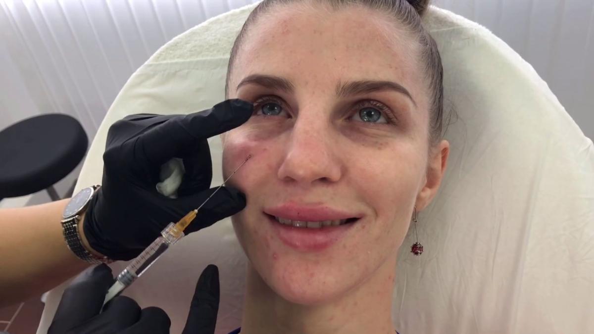 Can Filler Injections With PRP Plump Sunken Areas? by aestheticclinicdubai6@gmail.com