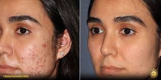 Best Acne Scar Treatments In Dubai & Sharjah At Glamorous Clinic Dubai by glamorous