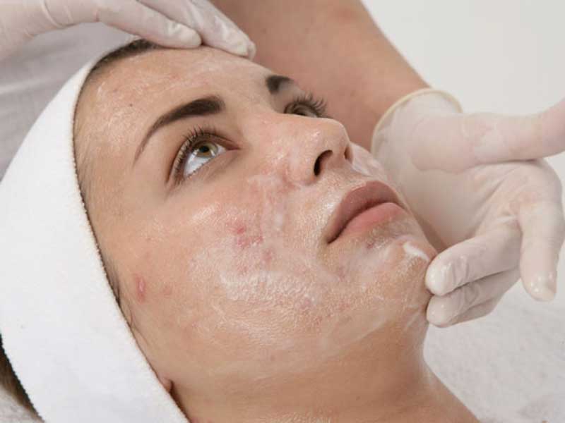How Often Should You Get A PCA Peel Treatment? How Often Should You Get A PCA Peel Treatment? by MuhammadAhmad
