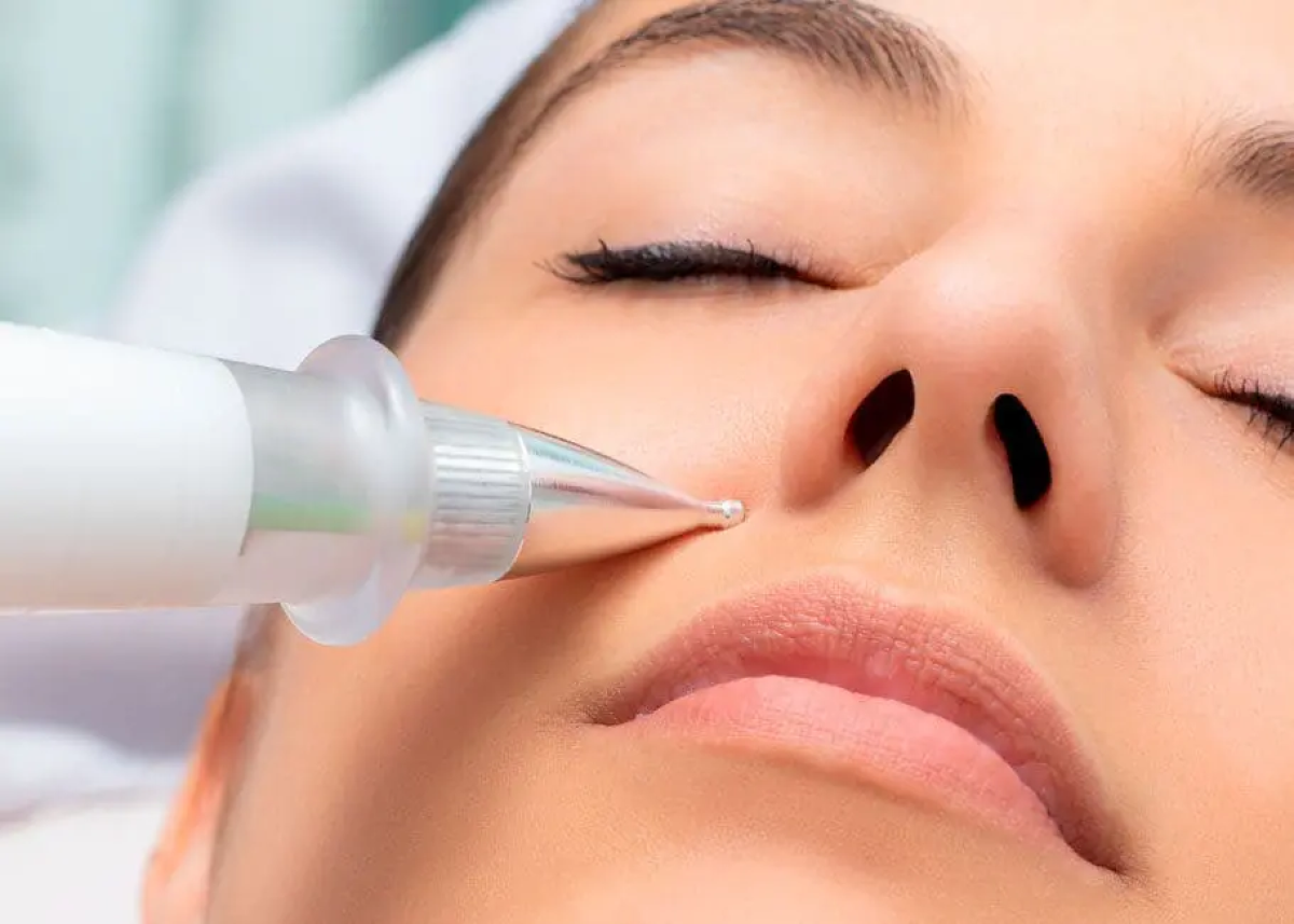Is Plasma Pen Treatment Better Than Laser Therapy? Is Plasma Pen Treatment Better Than Laser Therapy? by MuhammadAhmad